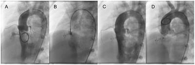 The Efficacy and Medium to Long-Term Follow-Up of Transcatheter Retrograde Closure of Perimembranous Ventricular Septal Defects via the Femoral Artery With Amplatzer Duct Occluder II in Children